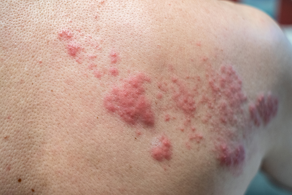 皮膚の病気 加古川市加古川町の皮膚科なら むらつ皮ふ科クリニック 皮膚やアレルギーに関するあらゆるご相談に応じます